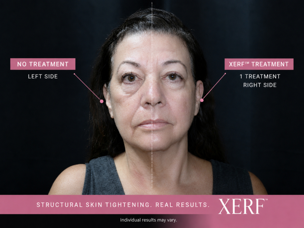 XERF structural skin tightening treatment treatment done at the medspa at lash moi, famously known for kim kardashian getting done in LA
